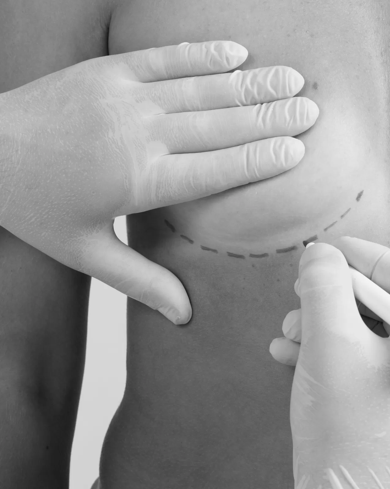 A gloved clinician marking a patient's skin before breast surgery