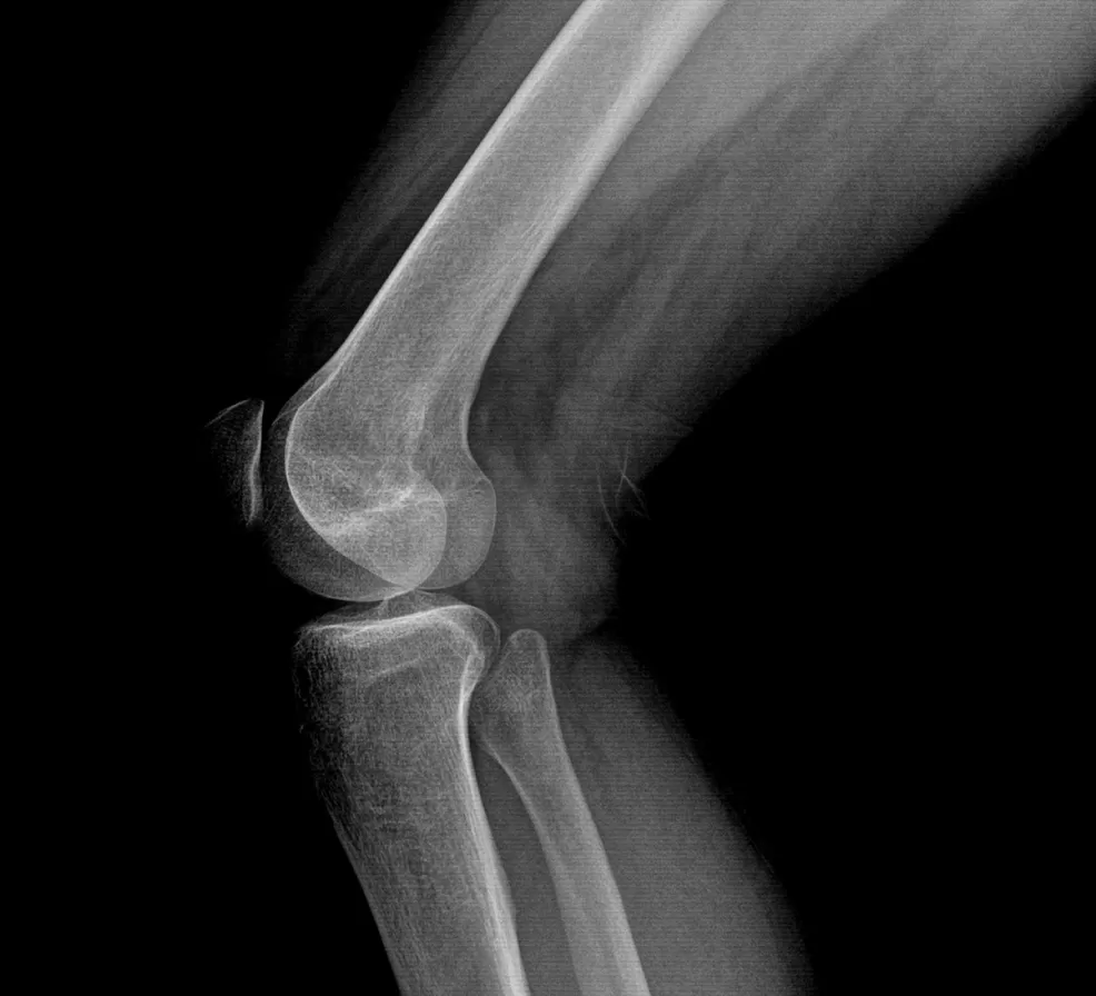 An X-ray of a knee joint from the side