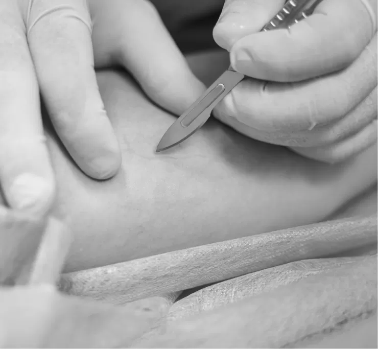 A gloved clinician performing a minor skin procedure with a scalpel
