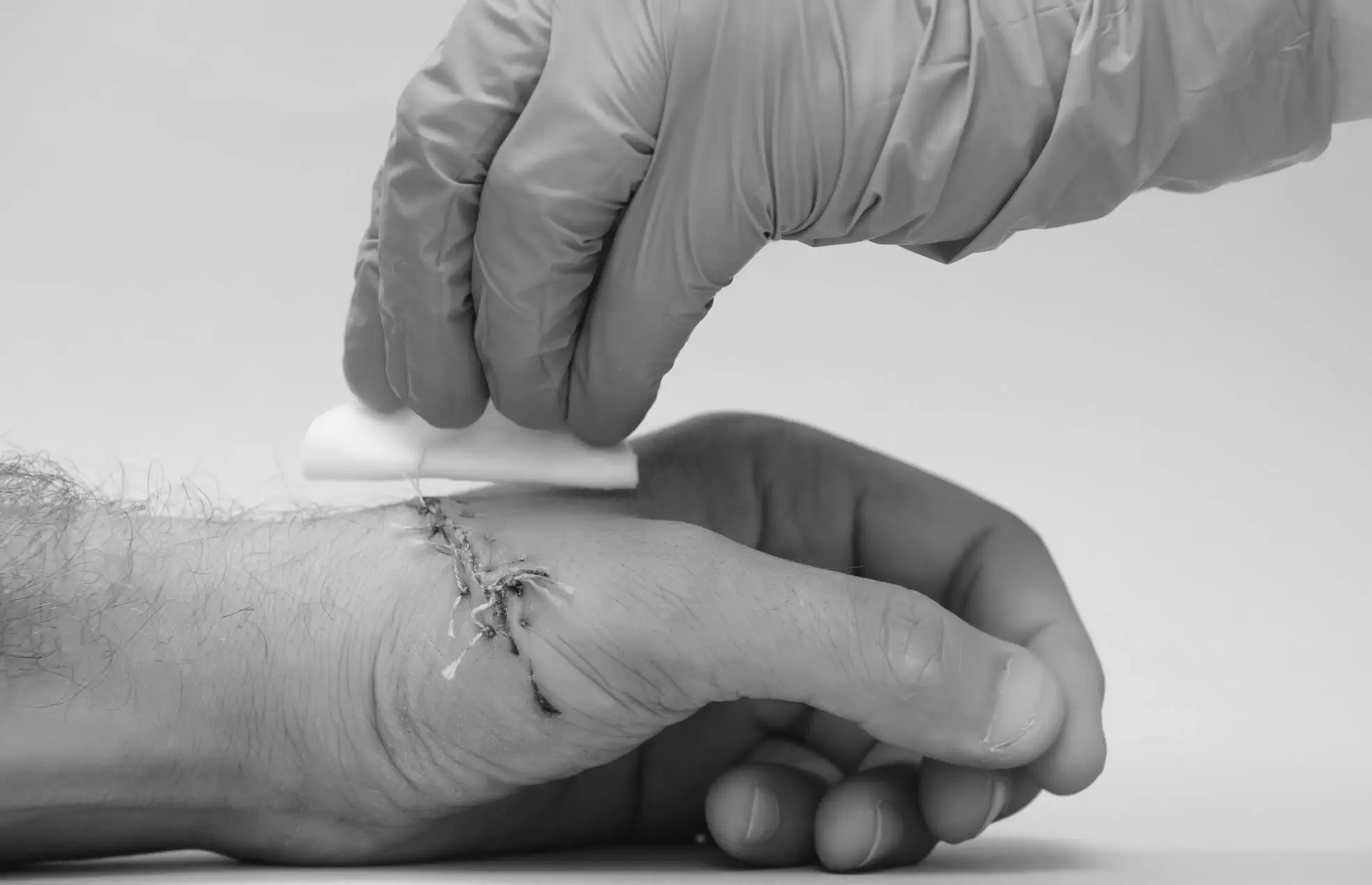 A gloved clinician placing a dressing over stitches on a patient's hand