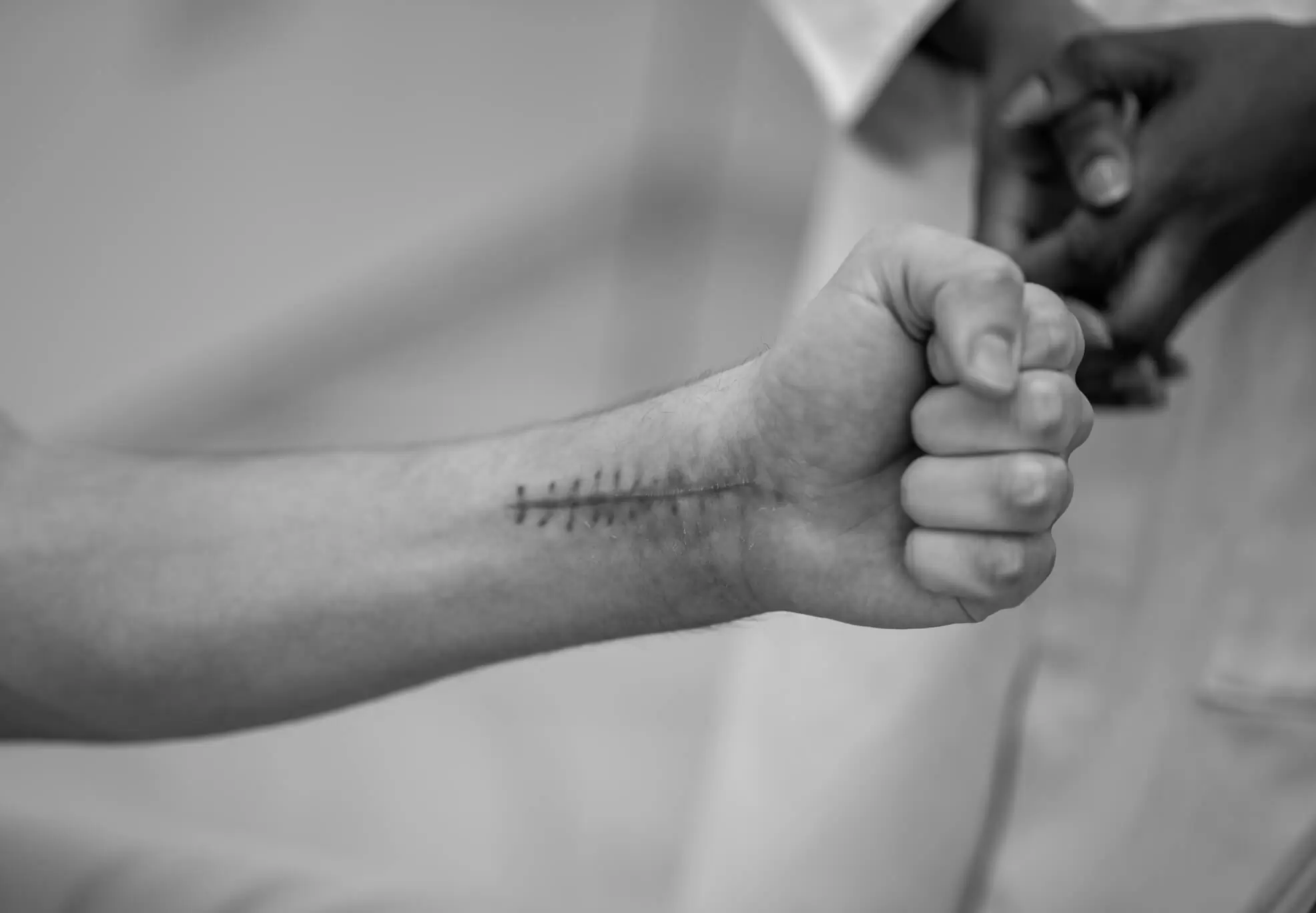 A row of stitches along a patient's forearm after a procedure