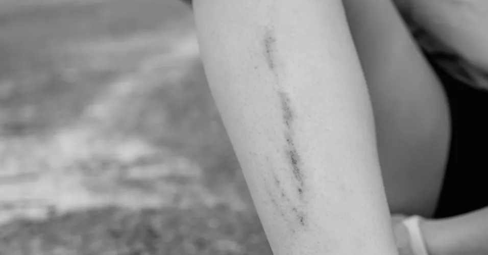 A sutured laceration on a person's lower leg